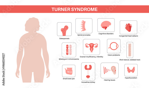 Turner syndrome poster