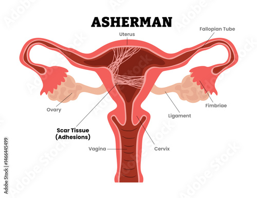 Asherman's Syndrome, intrauterine adhesions or intrauterine synechiae, female reproductive system, educational medical poster design healthcare scheme, internal organs cervix, fertility problem.