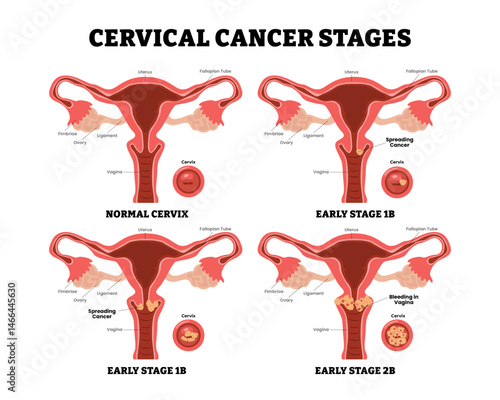 Cervical cancer stages process early stages progress, female reproductive system, educational medical poster design healthcare scheme, labeled internal organs cervix, fertility problem infertility.