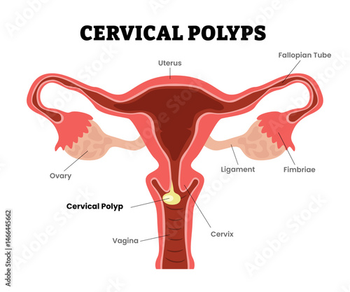 Uterine Polyps Endometrial Polyps, cervical polyps, female reproductive system, educational medical poster design healthcare scheme, internal organs cervix, fertility problem infertility