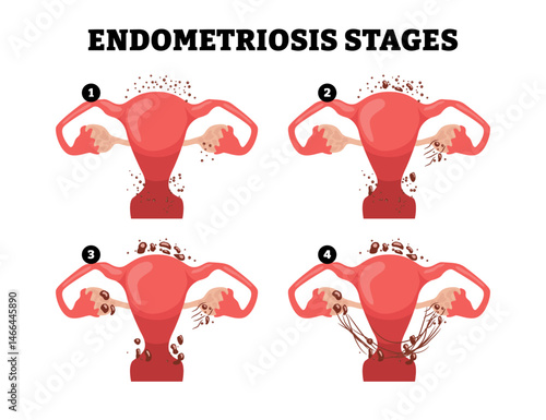 Stages of Endometriosis stages growth progress, female reproductive system, educational medical poster design healthcare scheme, labeled internal organs cervix, fertility problem infertility,