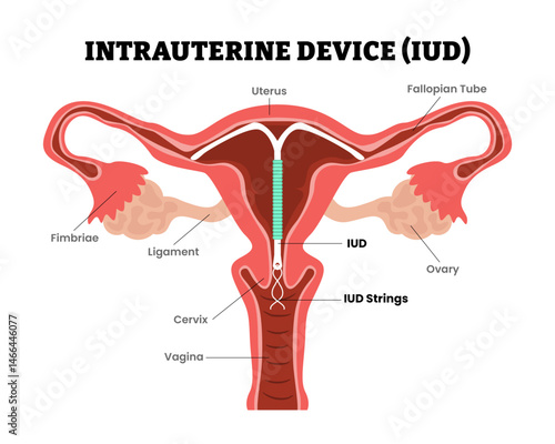 Intrauterine Device (IUD) or copper coil birth control, female reproductive system, educational medical poster design healthcare scheme, labeled internal organs cervix, fertility problem infertility.
