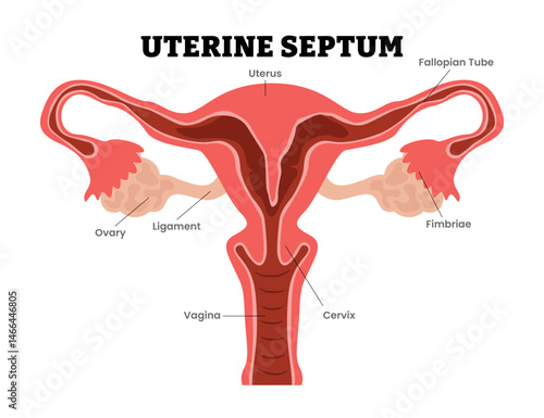 Uterine Septum Septate uterus, uterus divides into two, female reproductive system, educational medical poster design healthcare scheme, labeled internal organs cervix, fertility problem infertility.
