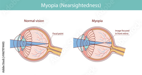 myopia. sick eye. vector illustration in cartoon style