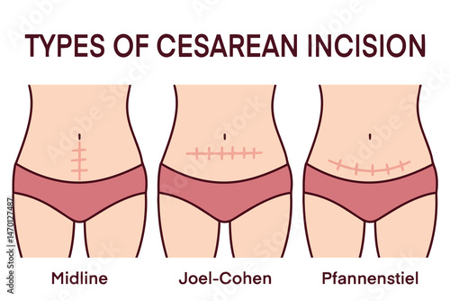 Medical illustration showing three types of cesarean section incisions on female bodies including midline, Joel-Cohen, and Pfannenstiel techniques, explaining surgical options, healing scars