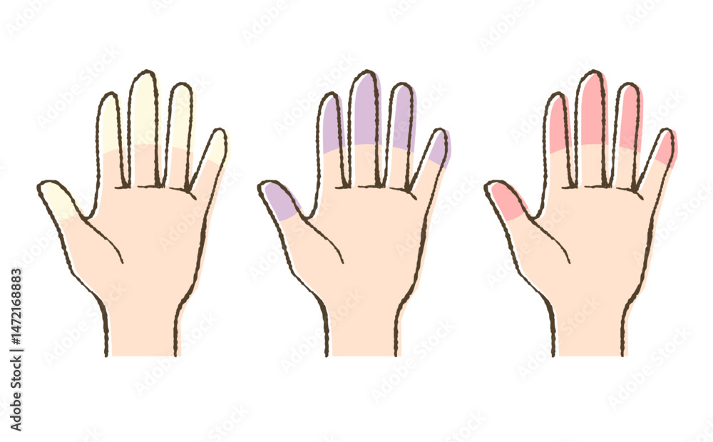 Obraz premium レイノー現象のイラスト・手指の血流障害の症状比較