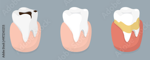Healthy and unhealthy tooth. Isometric vector illustration.