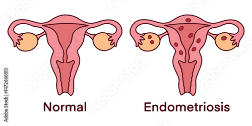 Medical illustration comparing normal healthy uterus with uterus affected by endometriosis, showing tissue growth outside the uterus, reproductive health issues, pain, menstrual problems