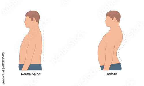 Lordosis vector illustration