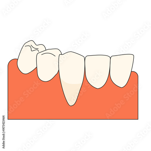 tooth abfraction