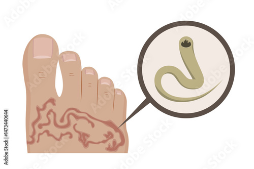 Hookworm causing cutaneous larva migrans infection in human foot
