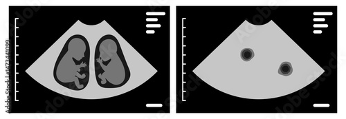 Ultrasound scan showing dichorionic diamniotic twins during pregnancy