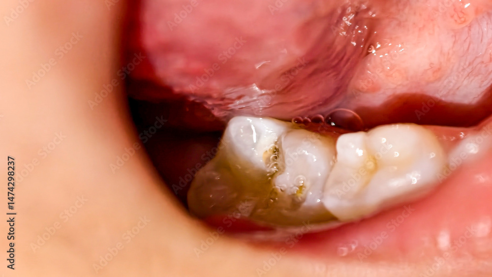 Fototapeta premium Dental Decay Close-up Showing Tooth Cavities and Gum Inflammation Visible
