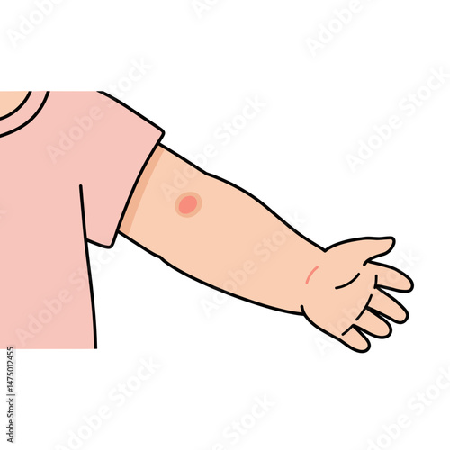 Child's arm showing a rash with pink shirt background  