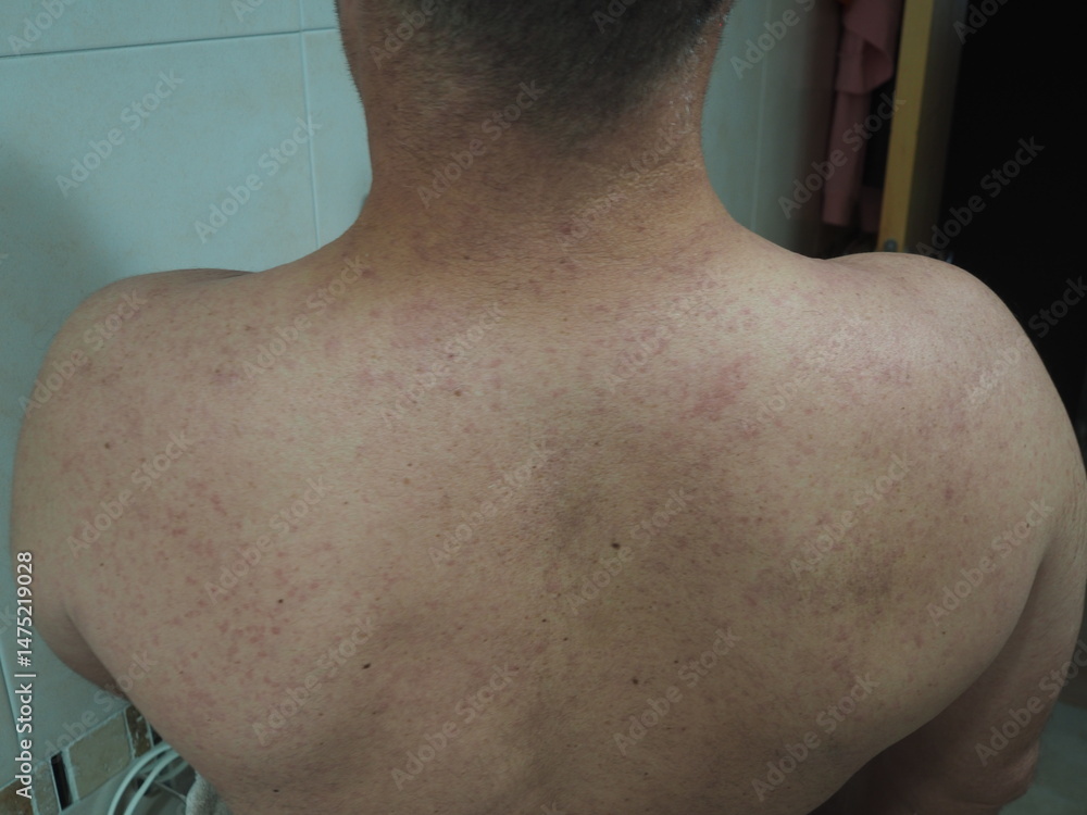 Naklejka premium Rear view of a person with eczema and dermatological skin problems.