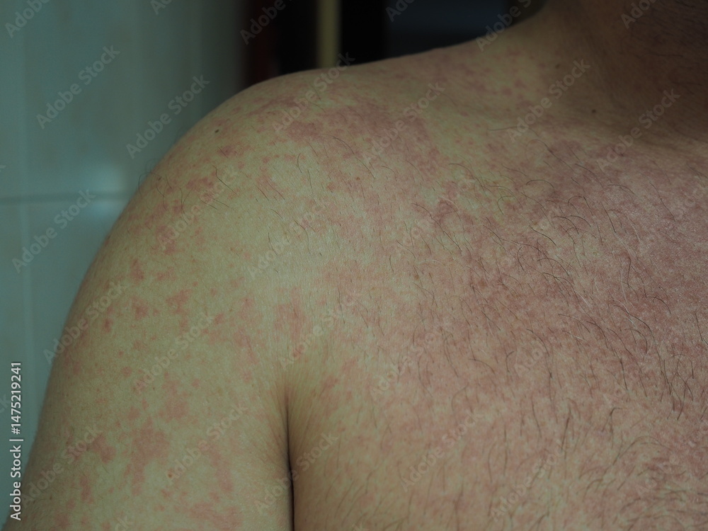 Fototapeta premium Detail of a person with allergic dermatitis.