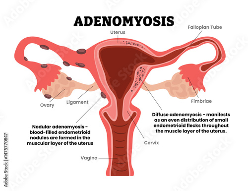 Adenomyosis, focal, adenomyoma, diffuse, female reproductive system, educational medical poster design healthcare scheme, internal organs cervix, fertility problem infertility. Internal endometriosis.