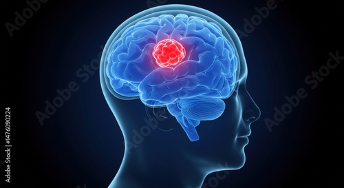 Wallpaper Mural Human Brain Cancer Anatomy Illustration Torontodigital.ca