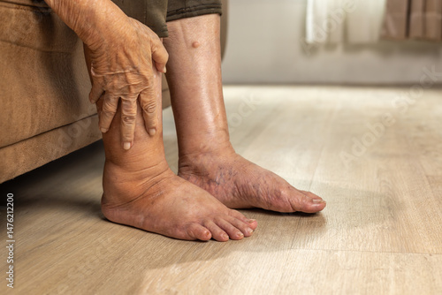Elderly woman has edema or swelling foot.