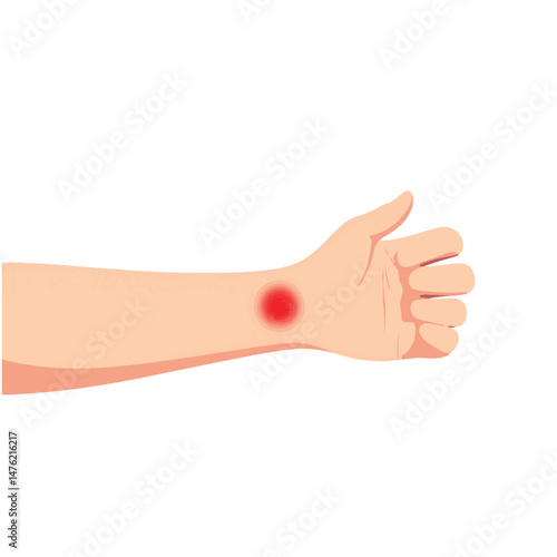 Child's itchy bug bite on forearm, educational medical illustration