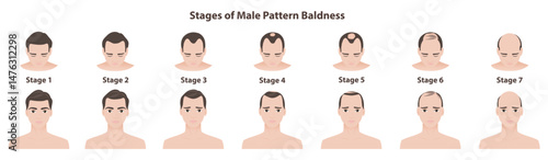 The stages of male pattern baldness vector illustration isolated on white background. The Norwood scale defines seven stages of male pattern hair loss or androgenetic alopecia. Hair care concept.