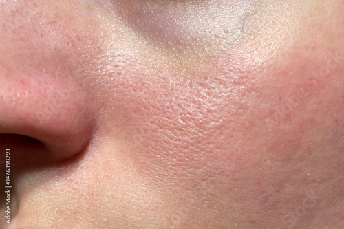 Natural female face close-up showing skin imperfections, large pores, redness and uneven tone. Realistic texture, high-resolution macro for skincare, dermatology, or cosmetic use.