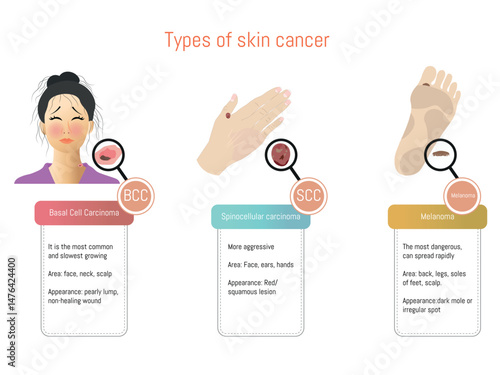 Recognizing skin cancer types, basal cell carcinoma, squamous cell carcinoma, and melanoma