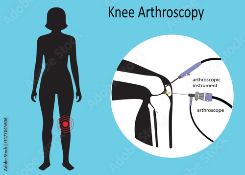 Knee Arthroscopy Procedure for Joint Surgery – Arthroscope and Arthroscopic Instruments in Use. Treatment for Leg Pain, Inflammation, and Cartilage Repair.