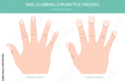 Digital Clubbing Nail Disease - Medical Infographic Vector Illustration