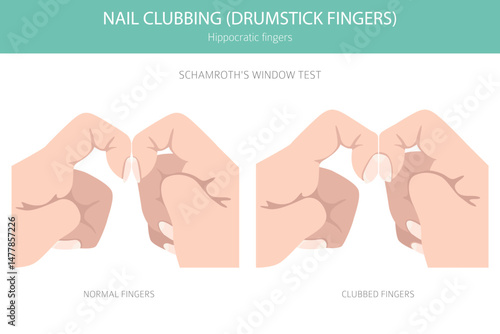 Digital Clubbing Nail Disease - Medical Infographic Vector Illustration