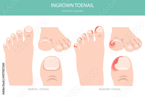 Ingrown toenail, or onychocryptosis, is a nail condition causing pain, redness, and swelling as the nail grows into the skin. Medical infographic. Vector illustration