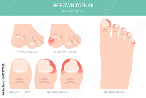 Ingrown toenail, or onychocryptosis, is a nail condition causing pain, redness, and swelling as the nail grows into the skin. Medical infographic. Vector illustration