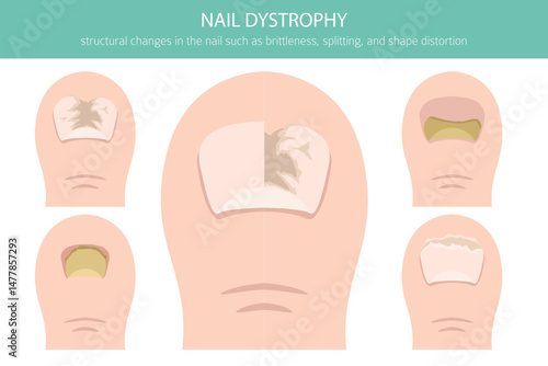 Nail dystrophy. Nail diseases. Medical infographic design.  Vector illustration
