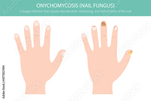 Medical vector illustration of onychomycosis – a common fungal toenail infection. Detailed infographic showing nail discoloration, thickening, and deformationh