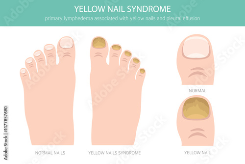 Yellow Nail Syndrome is a rare condition marked by thick, slow-growing yellow nails, often with lymphedema and respiratory issues. Medical infographic. Vector illustration