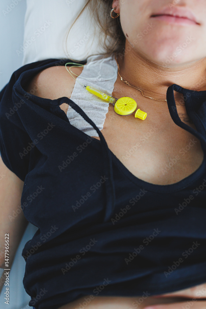The patient is currently equipped with an IV catheter and is being closely monitored in a hospital setting, where professional healthcare providers ensure optimal treatment and care during recovery
