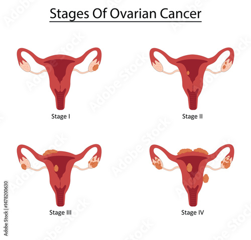 Stages of ovarian cancer vector illustration