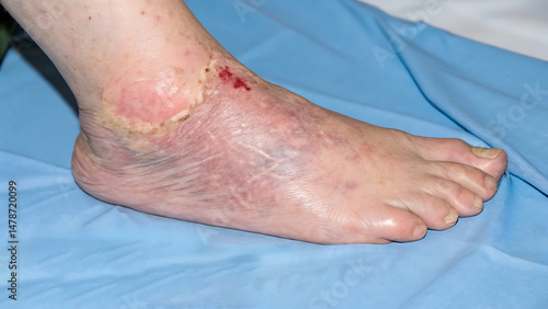 Foot Ulcer Caused by Vascular Damage – Hypertension and Diabetes Complication