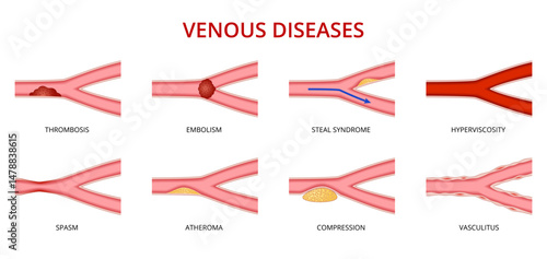 Human vein disease, venous disorders vector set. Thrombosis, embolism, steal syndrome, hyperviscosity, spasm, atheroma, compression and vasculitis. Health care or educational and medical infographics