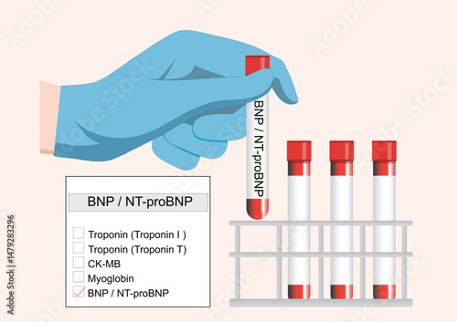 BNP and NT-proBNP are useful markers for diagnosing and monitoring heart failure.
