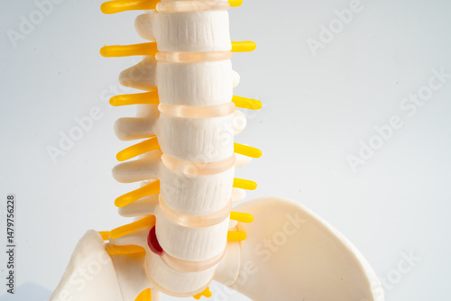 Lumbar spine displaced herniated disc fragment, spinal nerve and bone. Model for treatment medical in the orthopedic department.