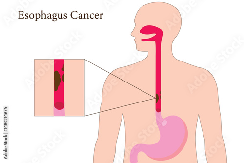 Human silhouette showing esophagus cancer with close-up medical illustration detail