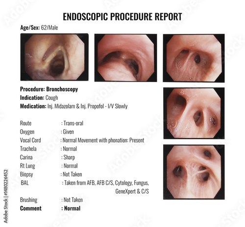 Bronchoscopy report of a 62-year-old Male patient