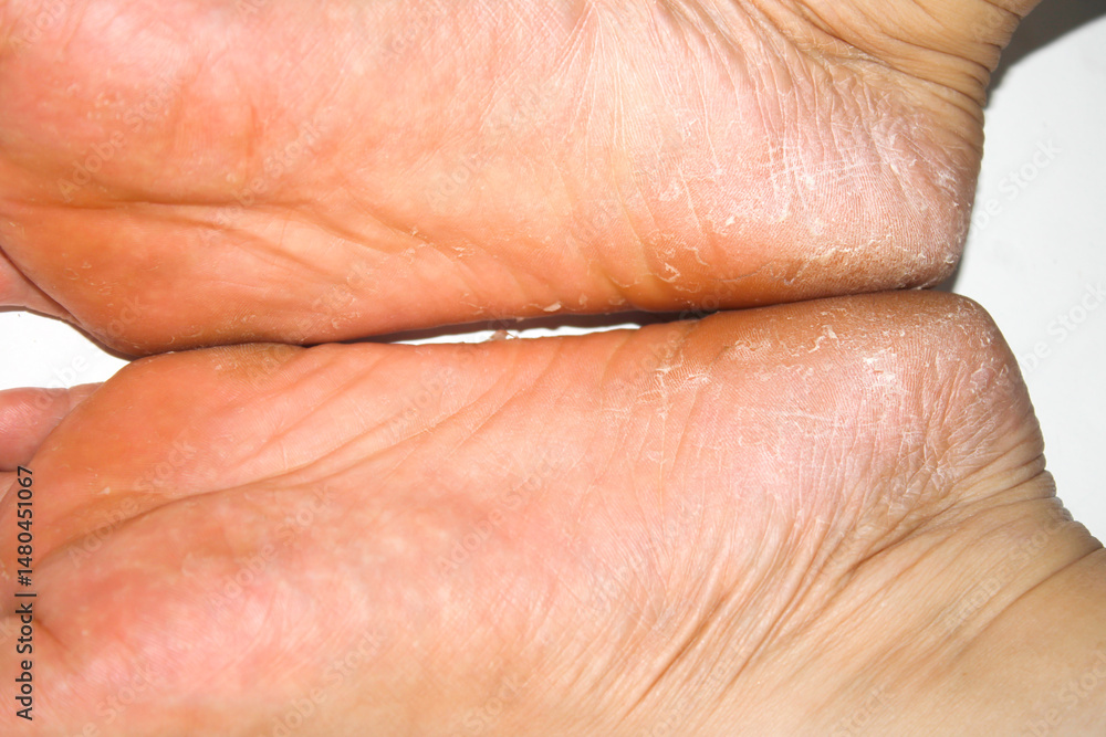 Fototapeta premium Close-Up View of Dry and Cracked Skin on Human Feet