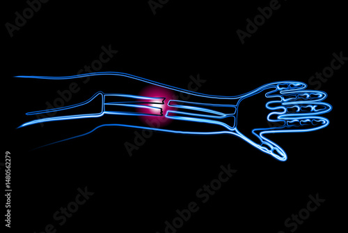 Vector isolated illustration of a closed forearm fracture. Outline drawing of a hand fracture. X-ray of the hand.
