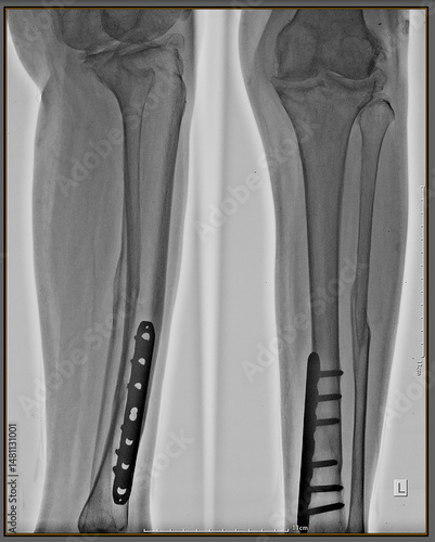 Quadro em tela X-ray metal in conventional radiological examination of the cruris or tibia fibu