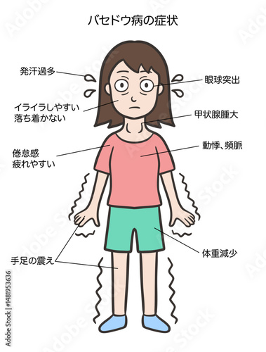バセドウ病のサイン、特徴的な症状、女性