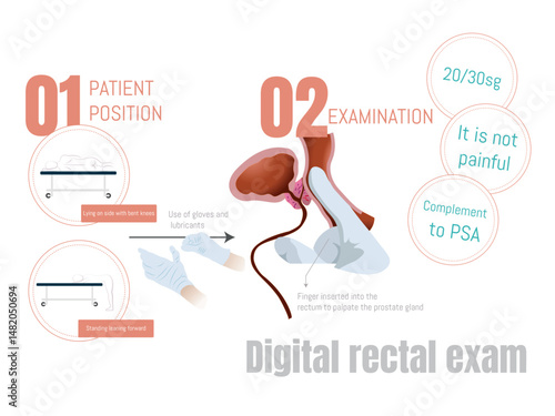 Digital rectal exam for prostate cancer screening and diagnosis