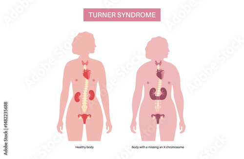 Turner syndrome poster