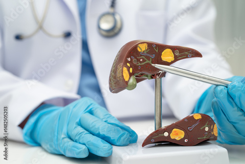 Cirrhosis, Liver cancer, fatty liver, Asian doctor with liver human anatomy model in World Hepatitis Day at hospital.